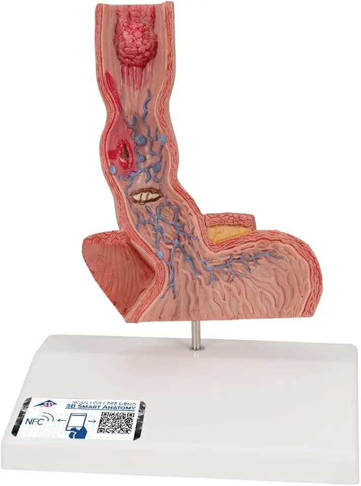 3B Scientific K18 Illnesses of the Esophagus - 3B Smart Anatomy